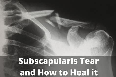 subscapularis tear healing time